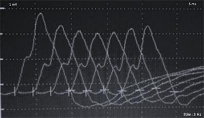 Myasthenia Gravis Induced by Ipilimumab in a Patient With Metastatic Melanoma